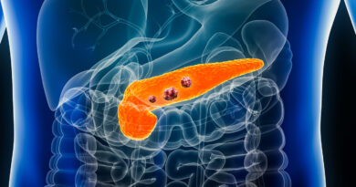 Un nuevo fármaco duplica la supervivencia a un año en un ensayo de cáncer de páncreas